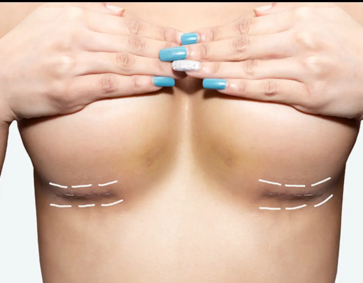 Breast implant scars scars Restora ink