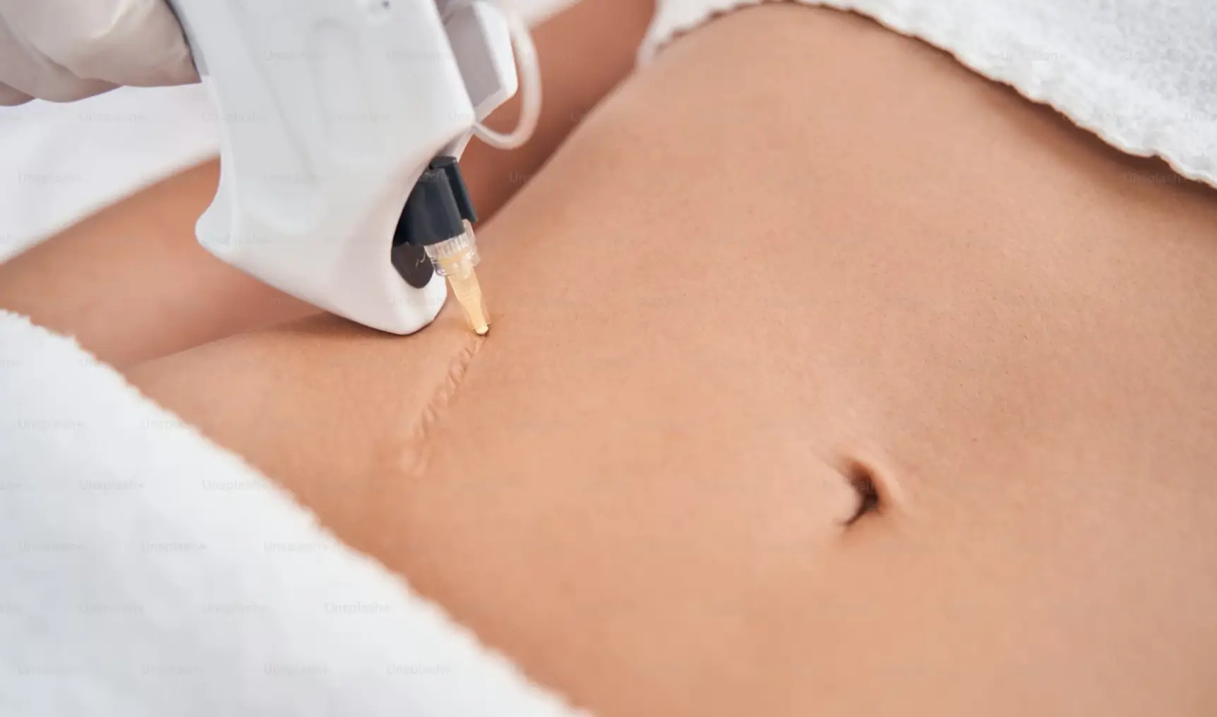 Surgical Scars Restora Ink