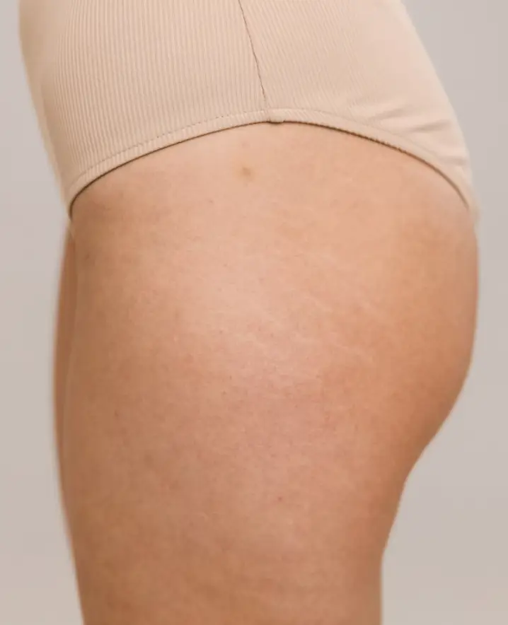 Stretch Marks Restora Ink