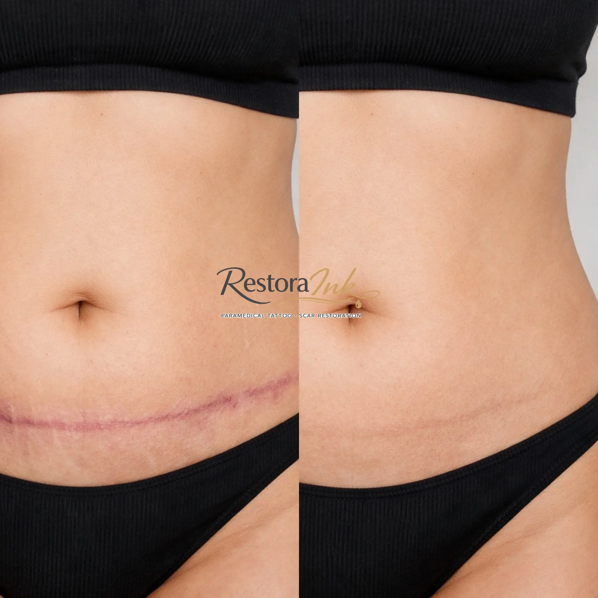 Tummy Tuck scars Restora ink